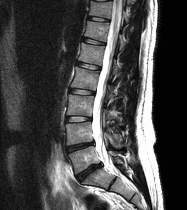 Image of an MRI Bone Scan