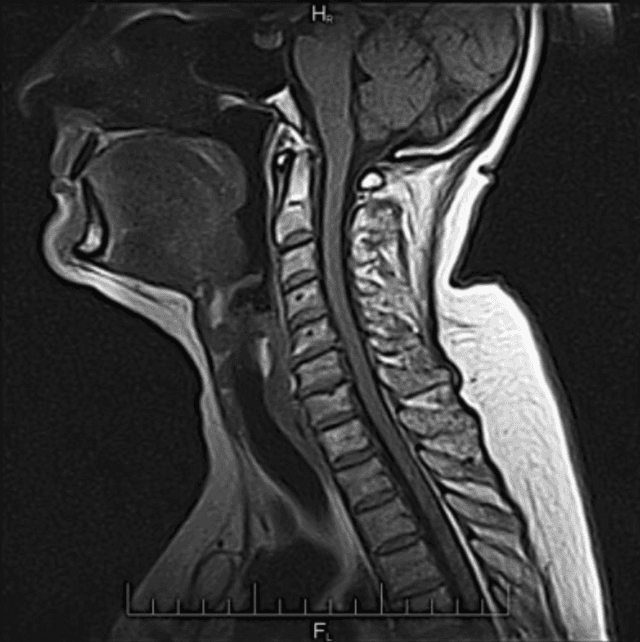 Image of an MRI Bone Scan